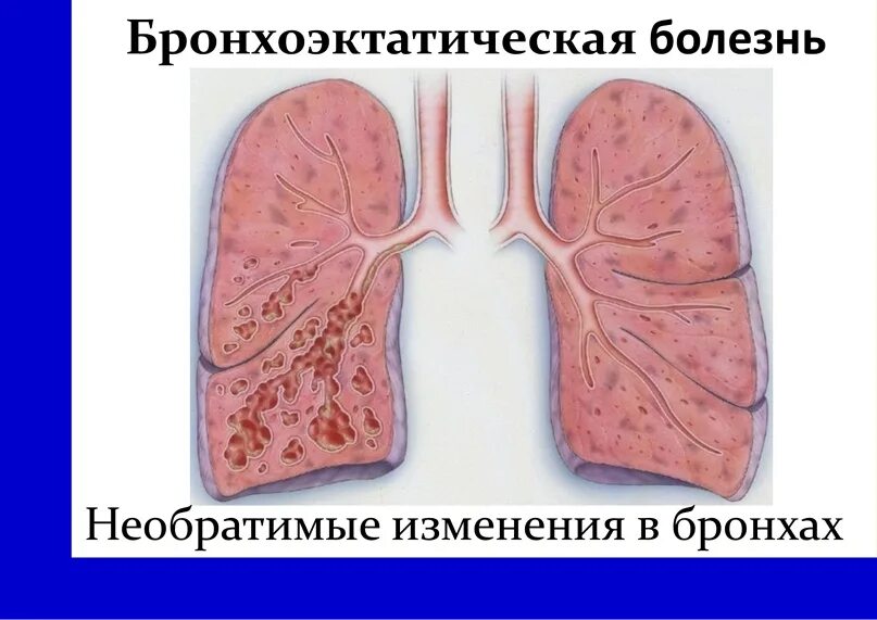 Что такое бронхоэктазы