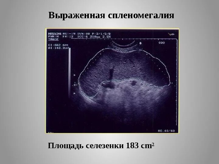 Спленомегалия селезенки УЗИ. УЗИ селезенки при спленомегалии. Патологии селезенки УЗИ норма. Увеличенная селезенка на УЗИ. Расширенная селезенка