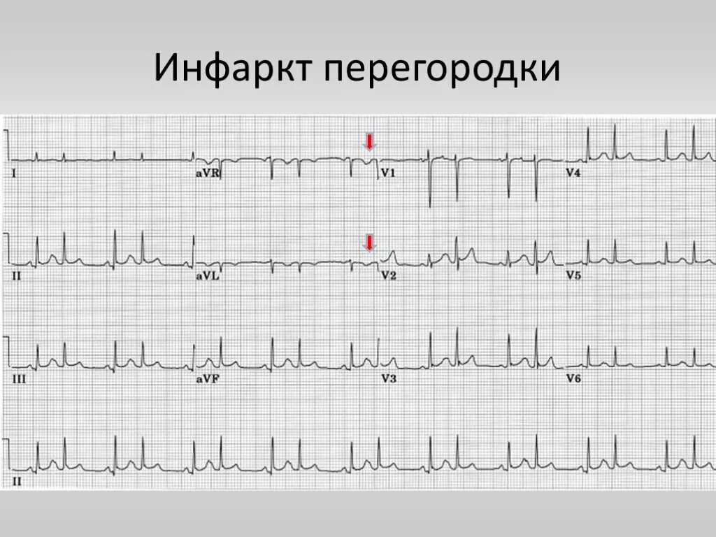 Руденко инфаркт. Сердечный приступ. Руденко инфаркт. Сердце после инфаркта миокарда. V тип инфаркта миокарда обусловлен.