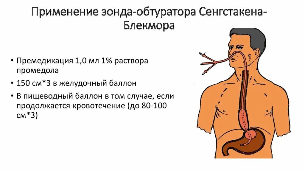 Остановка кровотечения из расширенных вен пищевода. Зонд Блекмора пищеводно- желудочный. Зонд обтуратор Блэкмора. Зонда-обтуратора Сенгстакена-Блэкмора. Зонд для остановки желудочного кровотечения.