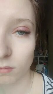Опухло веко после наращивания