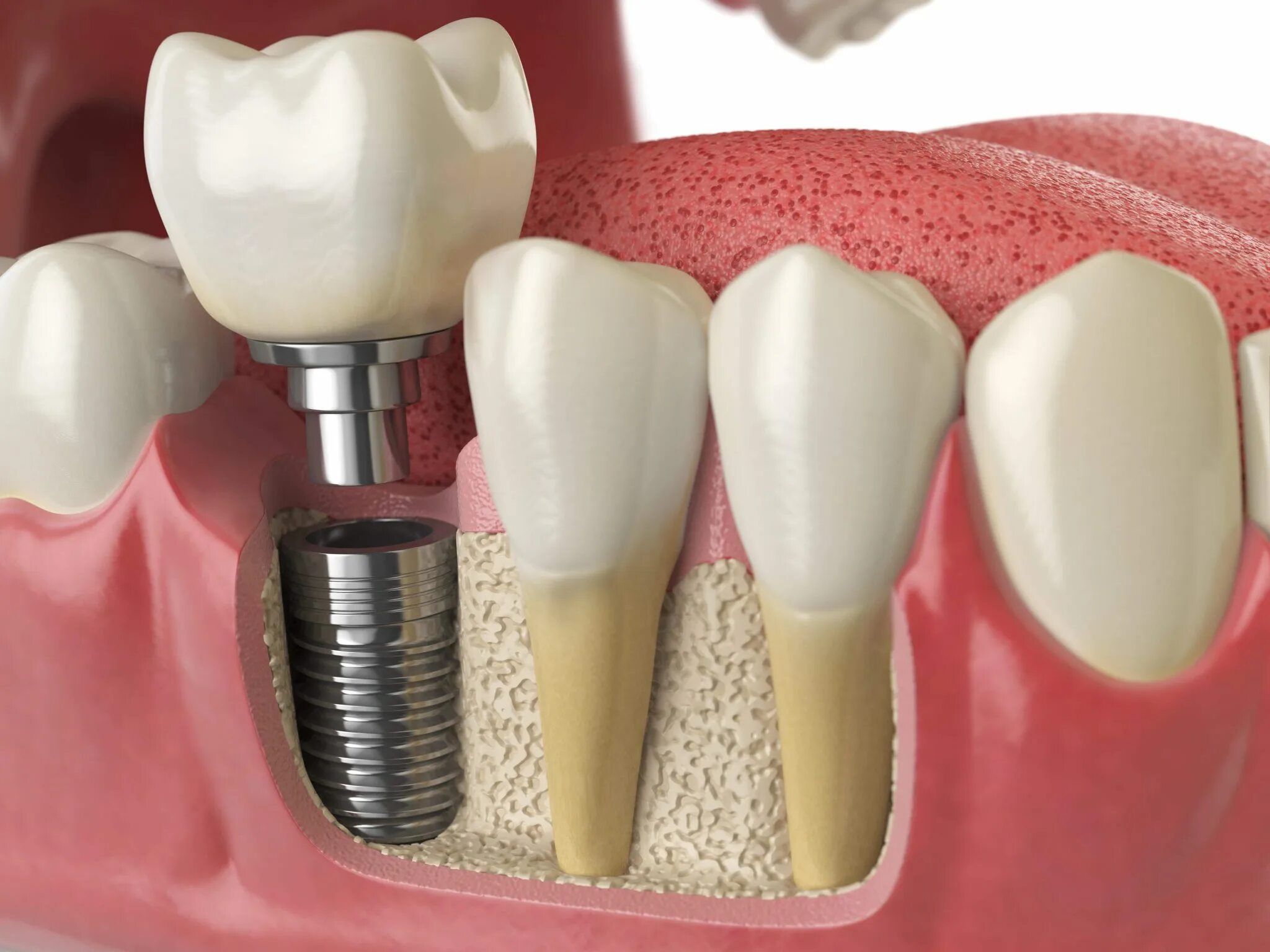 Протезист рейтинг. Имплантаты Dentium Superline. Синус-лифтинг (костная пластика, остеопластика). Зубные имплантаты Straumann.