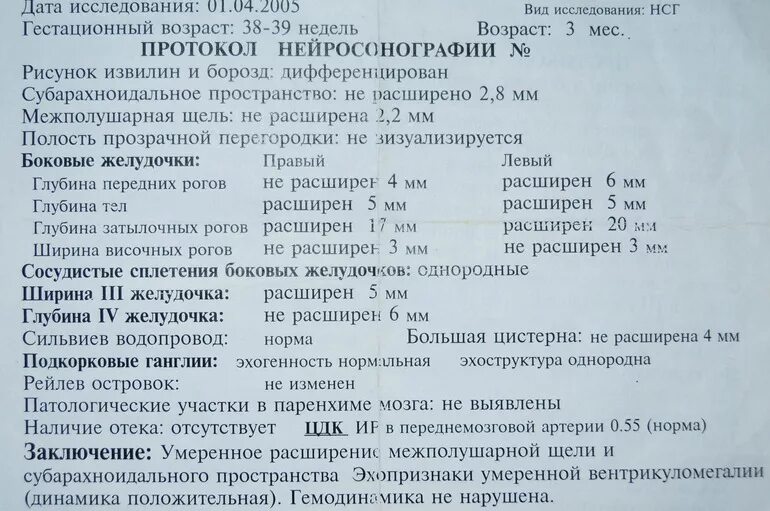 Расширение желудочков у новорожденного