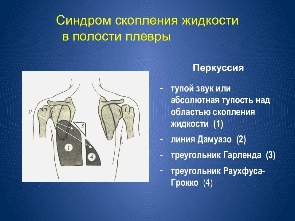 Перкуссия легких при гидротораксе звук. При скоплении жидкости в плевральной полости перкуторный звук. Скопление жидкости в полости плевры. Гидроторакс звук при перкуссии. Наличие крови в плевральной полости