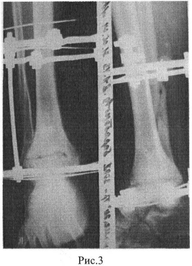 Артродез голеностопного сустава аппаратом Илизарова. Артродез коленного сустава с аппаратом Илизарова. Артродез межтарсального/тарсометатарсального сустава.. Артродез суставов операция