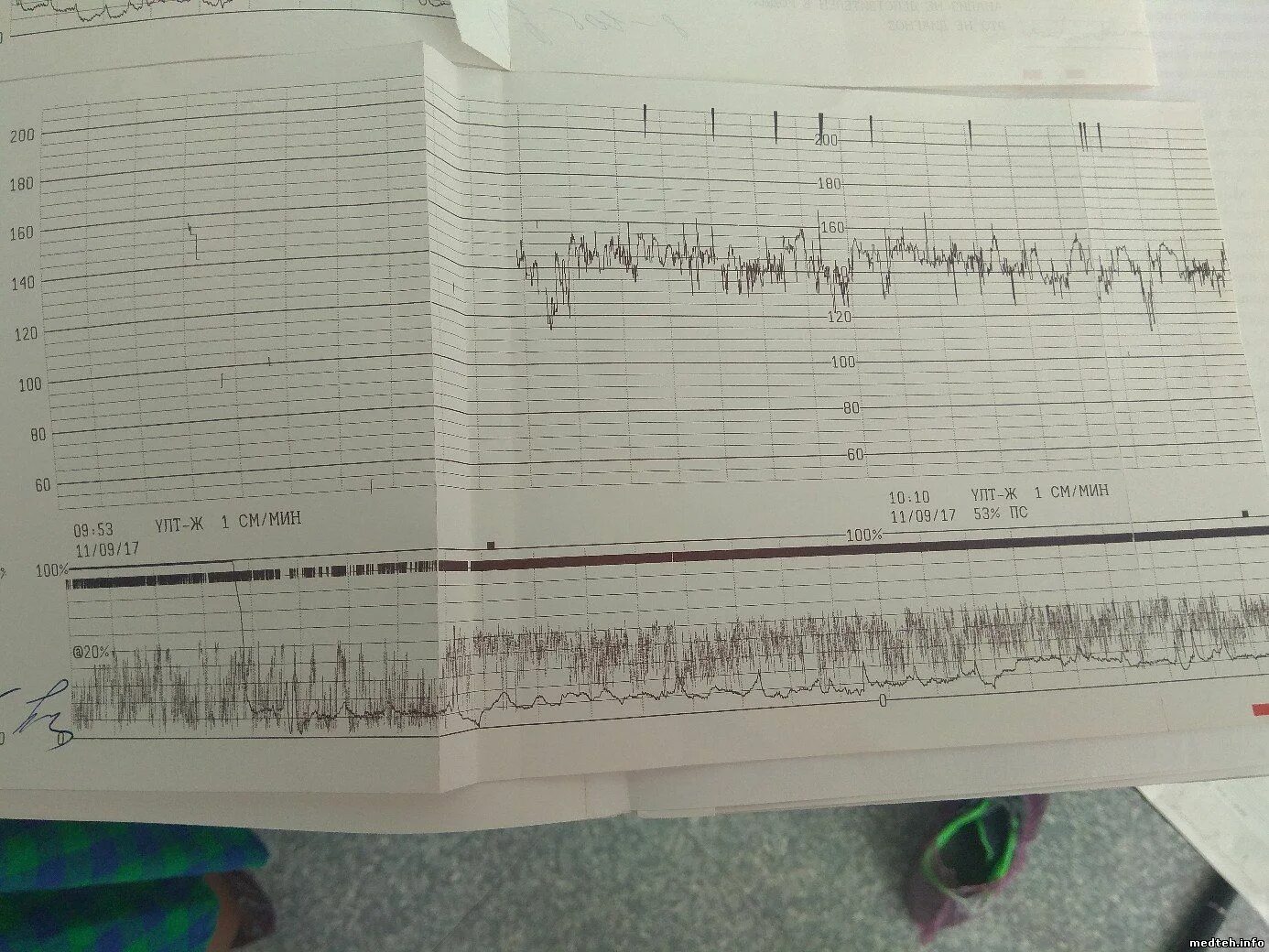 Датчики КТГ на экране. Тонус матки на КТГ. Сокращения на КТГ. Маточные сокращения на КТГ. Тонус на 39 неделе