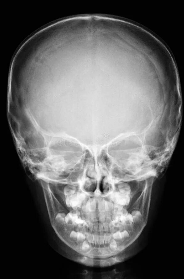 Рентгенограмма черепа новорожденного. Череп младенца рентгеновский снимок. Рентген снимок черепа ребенка. Детский череп рентген