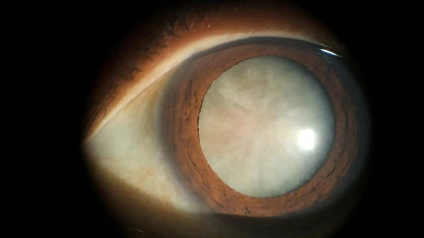 Кольцевидная катаракта Фоссиуса. Заднекапсулярная катаракта. Диабетическая катаракта биомикроскопия. Начальная старческая катаракта