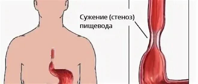 Рубцовые сужения пищевода