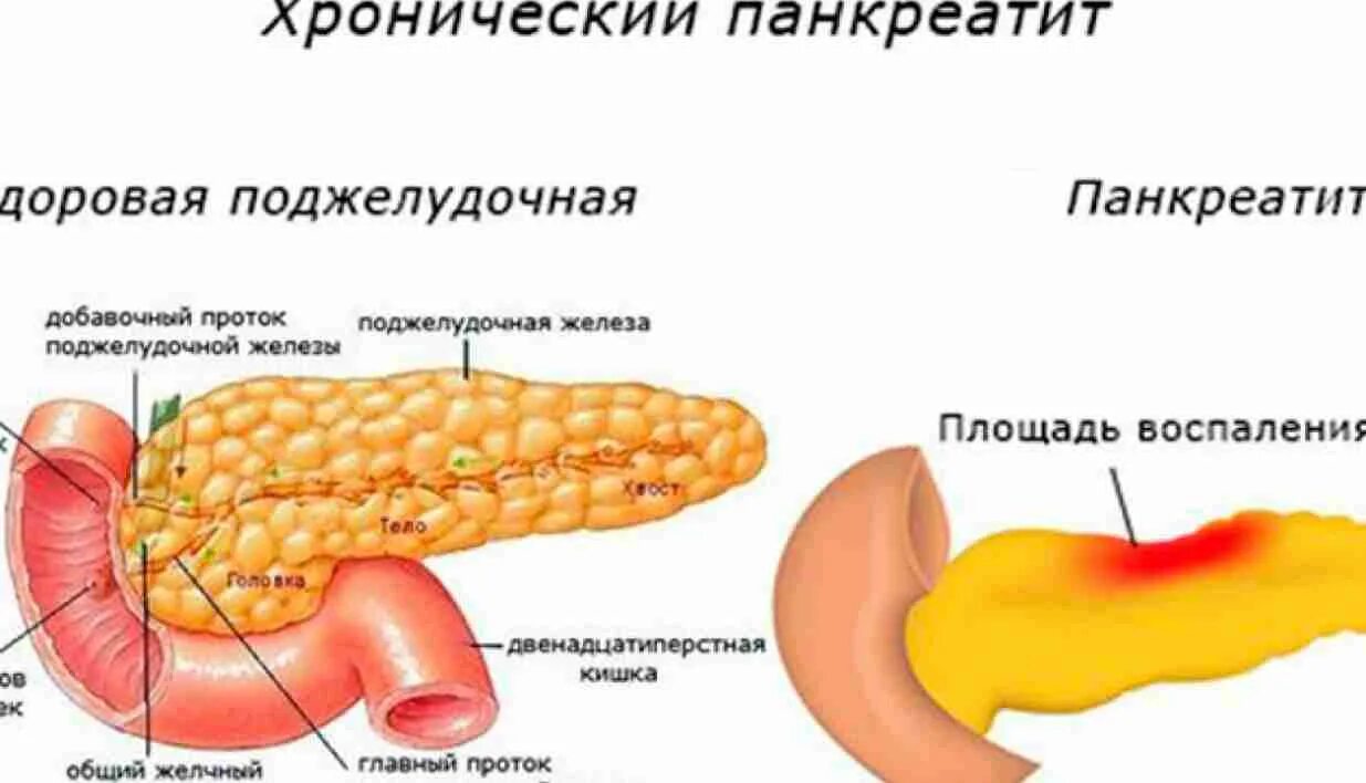 Воспаление печень поджелудочная железа. Болезнь хронический панкреатит поджелудочной железы. Хроническое воспаление поджелудочной железы. Поражения поджелудочной железы иллюстрации. Симптомы хронического панкреатита поджелудочной железы.