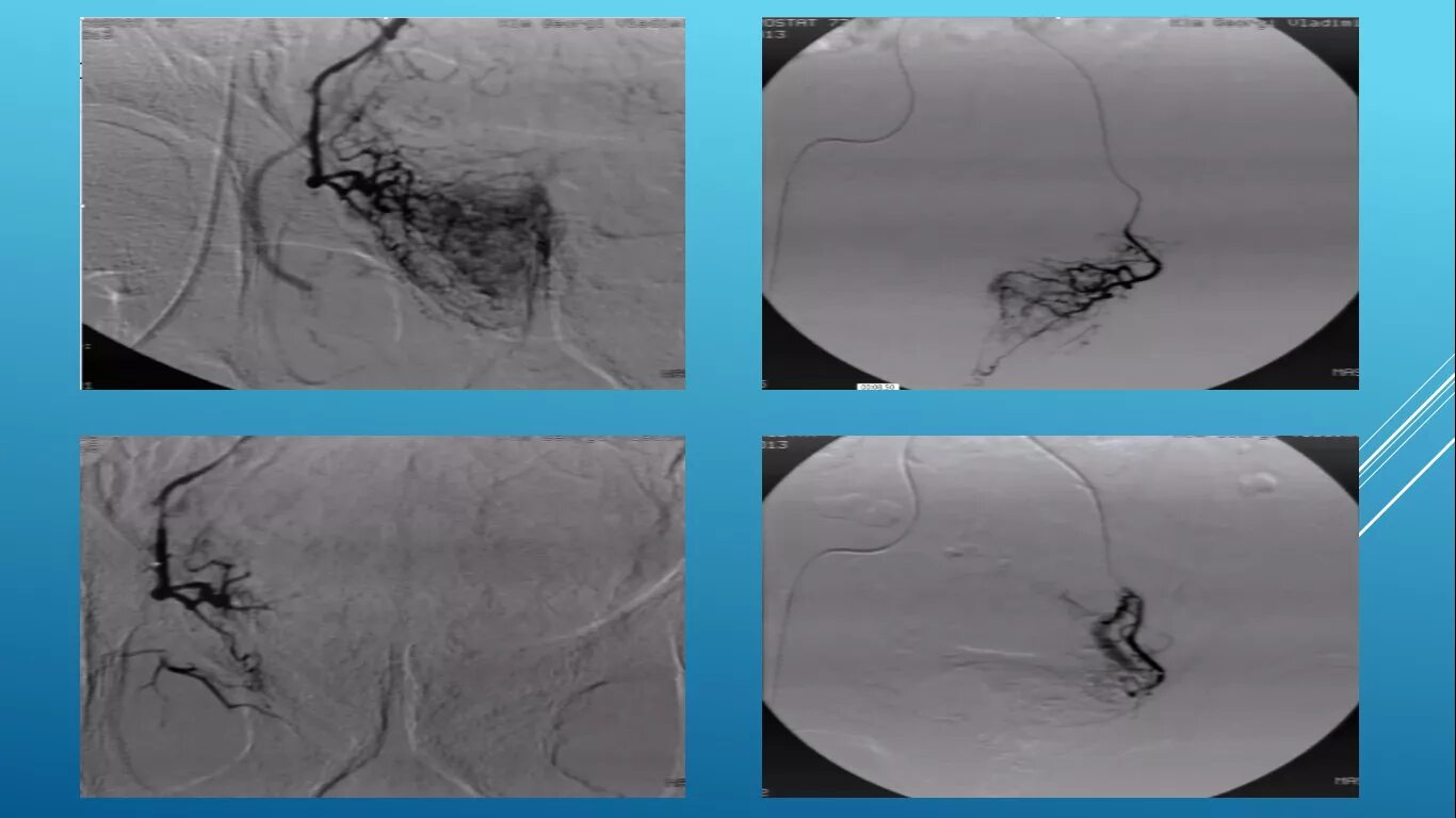 Эмболизация артерий простаты. Эндоваскулярная эмболизация простатических артерий. Эндоваскулярная эмболизация простатических артерий. Простатическая артерия. Эндоваскулярная эмболизация артерий простаты.