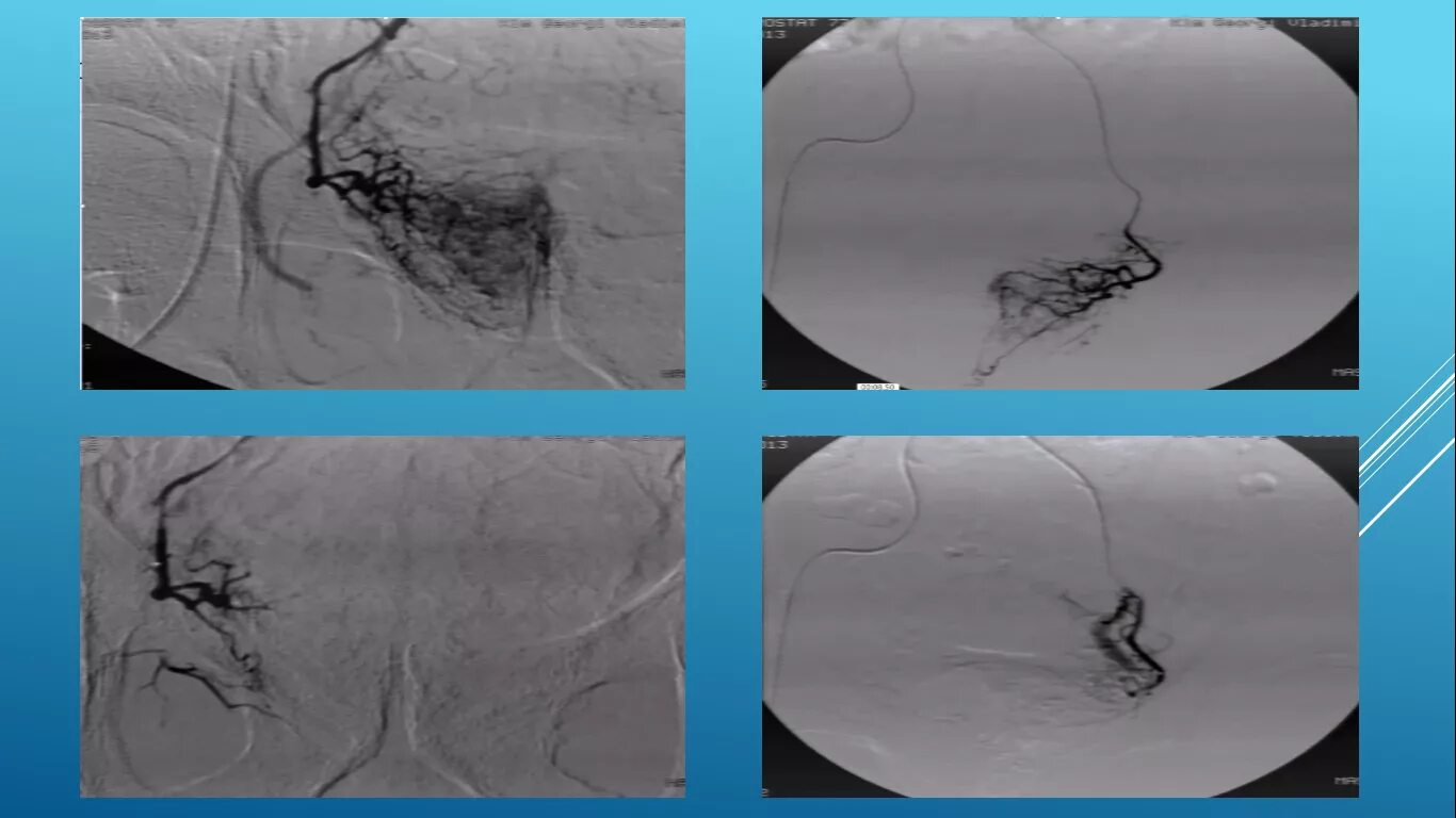 Артерии простаты. Эндоваскулярная эмболизация простатических артерий. Эмболизация предстательной железы. Химиоэмболизация мочевого пузыря. Эмболизация артерий предстательной железы.