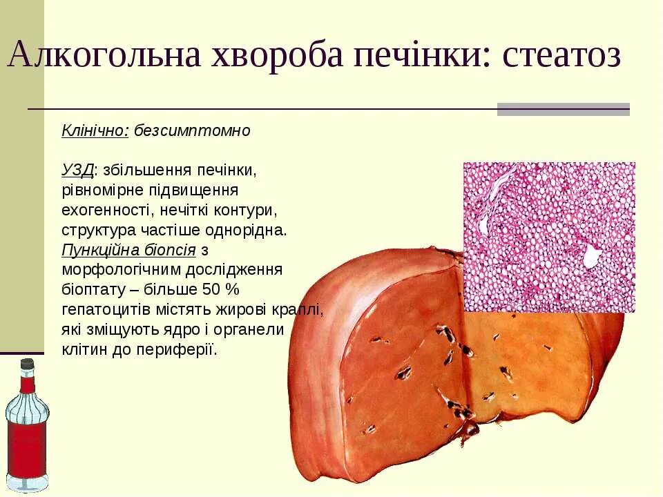 Признаки стеатоза печени. Образное название печени при стеатозе. Степени стеатоза печени. Стадии стеатоза печени.