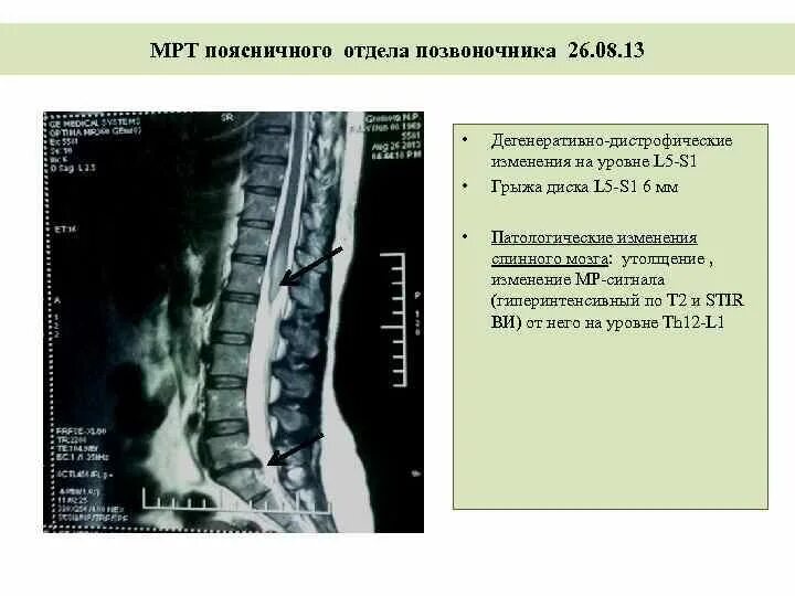 Дегенеративные-дистрофических изменений l1-s1. Дегенеративные изменения грудного отдела позвоночника что это такое. Дистрофия поясничного отдела позвоночника. Дистрофические изменения поясничного отдела дистрофузия. Начальное дегенеративные изменения шейного отдела