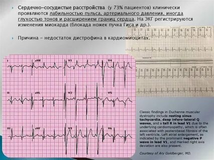 Что означают диффузные изменения миокарда