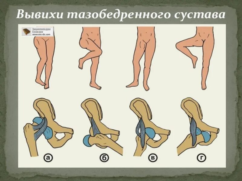 Растяжение связок тазобедренного сустава симптомы. Вывих тазобедренного сустава. Растяжение связок тазобедренного сустава. Подвывих тазобедренного сустава. Внешняя ротация тазобедренного сустава.