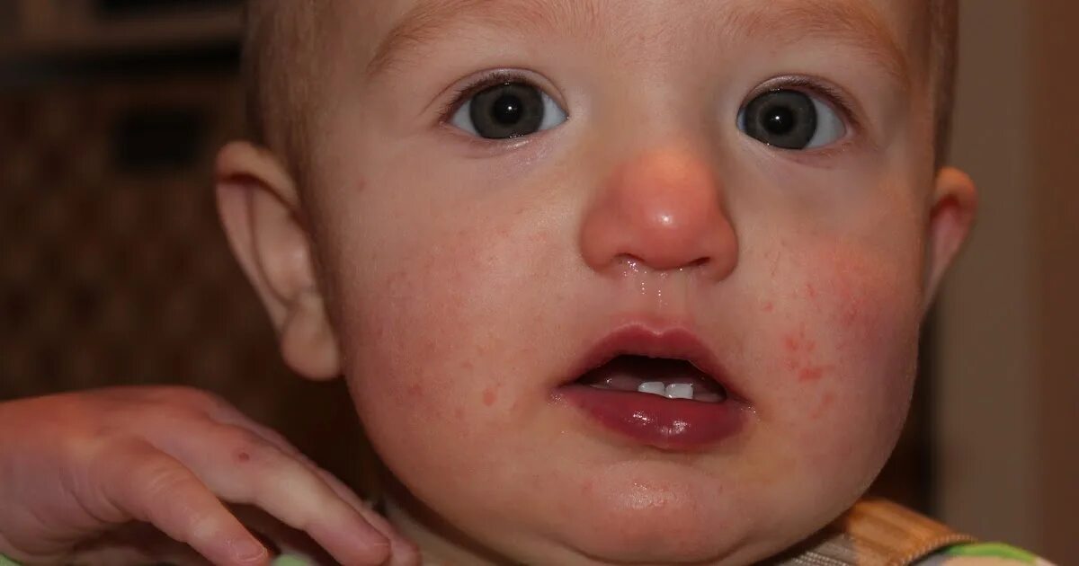 Ребенок 1 5 года насморк. Красный нос у младенца.