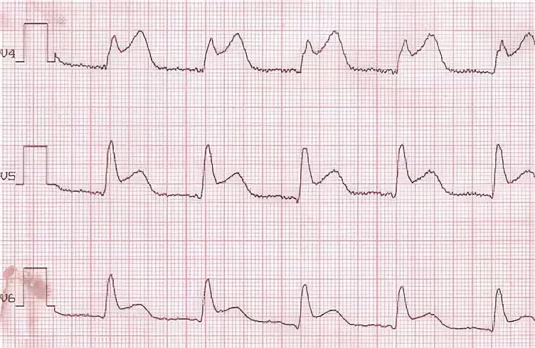 ОИМ С подъемом St ЭКГ. ЭКГ без подъема сегмента St. Окс с депрессией St на ЭКГ. Подъем сегмента St на ЭКГ. Без подъема st на экг