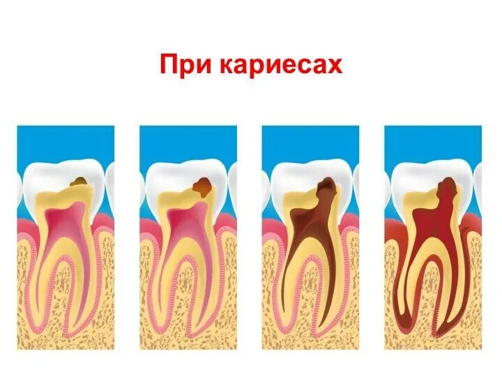 Кариес передается от человека к человеку. Кариес зуба сбоку восьмерка.