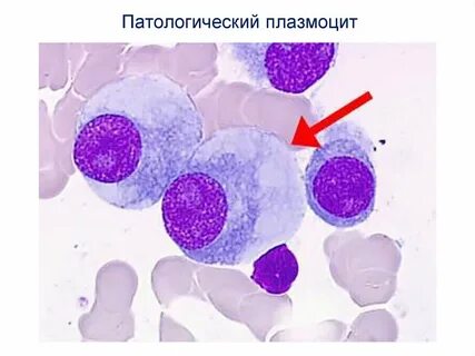 Миеломная болезнь лейкоз