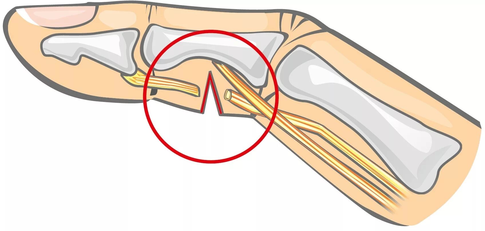 Разрыв сухожилия сгибателя мизинца. Сухожилия разгибателей кисти. Сухожилие разгибателя 2 пальца. Операция на большом пальце руки