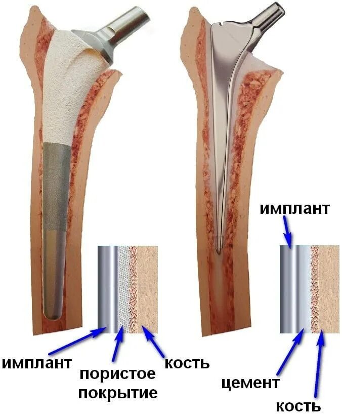 Замена тазобедренного сустава как проходит операция. Бесцементные эндопротезы тазобедренного сустава. Цементный эндопротез тазобедренного сустава. Эндопротез тазобедренного сустава цементной и бесцементной фиксации. Цементная фиксация эндопротеза тазобедренного сустава.