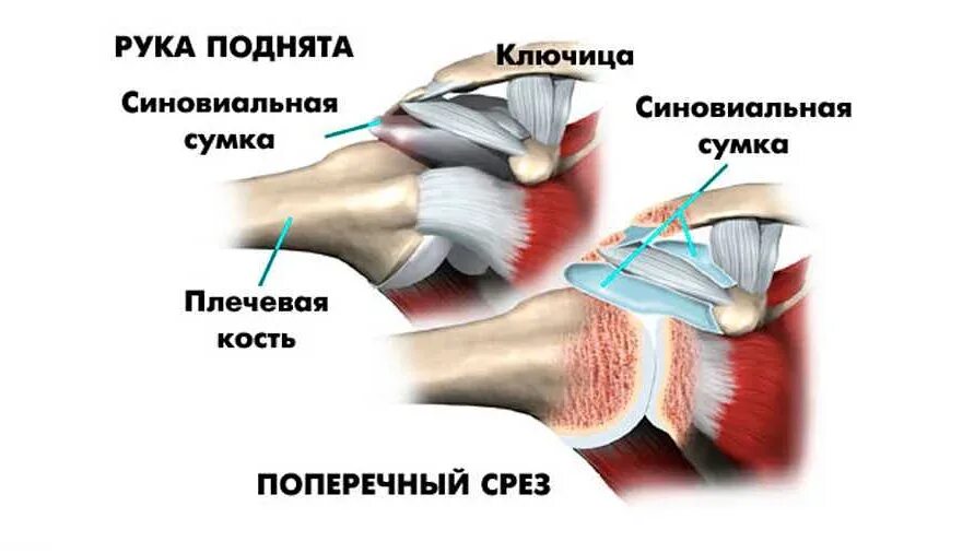 Дефекты посадки проймы. Не поднимается рука вверх причины. Поднятие руки в плечевом суставе. Вправление вывиха плечевого сустава. Боли в шее при подъеме руки вверх.