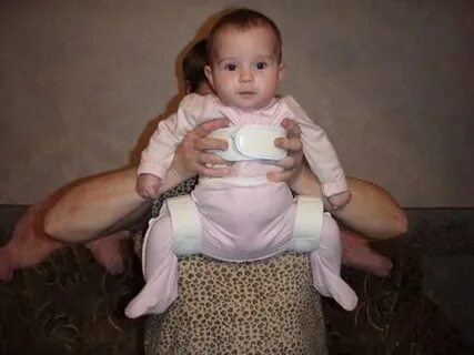 Дисплазия тазобедренного сустава шина