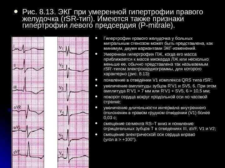 ЭКГ при гипертрофии предсердий и желудочков сердца. Изменения на ЭКГ при гипертрофии левого желудочка. ЭКГ при гипертрофии левого желудочка. ЭКГ синдром гипертрофии желудочков. Неспецифические изменения нижней стенки