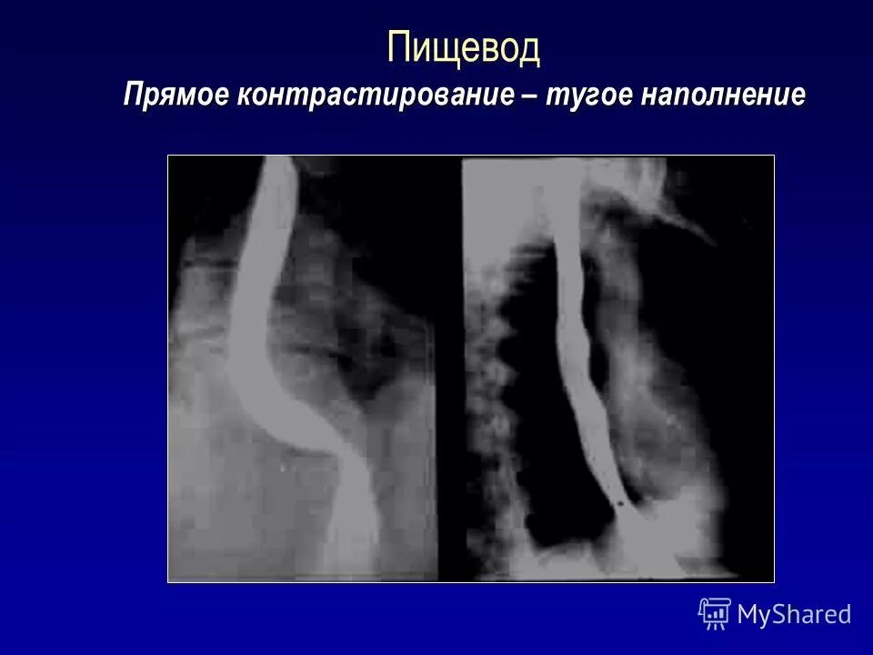 Тугое контрастирование пищевода. Двойное контрастирование пищевода. Контрастирование пищевода рентген. Тугое наполнение пищевода рентген. Скопия пищевода