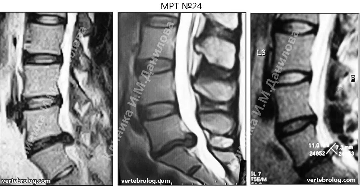 Протрузии межпозвонковых дисков l4 s1. Грыжа дисков l5-s1. Межпозвоночная грыжа l5-s1. Протрузии диска l5-s1. Грыжа межпозвоночного диска поясничного отдела l5-s1.