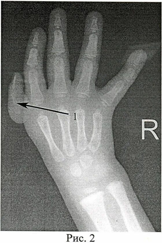 Пальцев 1 том. Гипоплазия фаланги пальцев. Стенозирующий лигаментит 1 пальца кисти. Гипоплазия 1 пальца кисти рентген. Гипоплазия большого пальца руки.