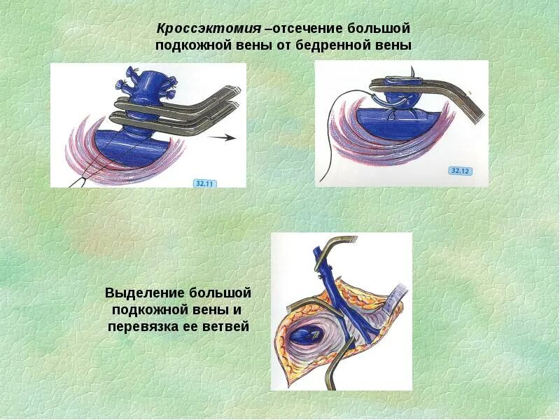 Кросэктомия. Операция троянова-тренделенбурга техника. Кросэктомия. Недостаточно клапана соустья. Сафено-поплитеальное соустье несостоятельно что это.