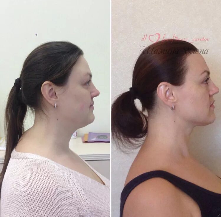 Второй подбородок у худых. Липосакция подбородка. Второй подбородок у худых. Двойной подбородок. Второй подбородок у худых девушек.