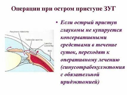 Острый приступ глаукомы