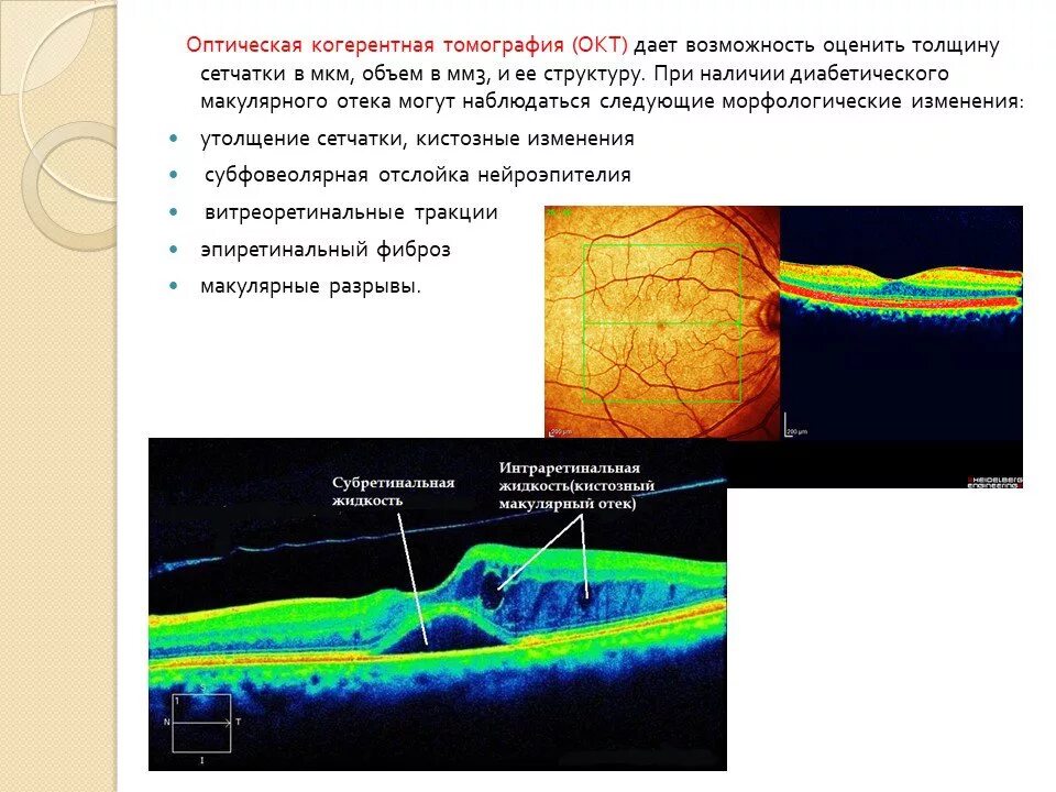 Макулярный отек лечение. Тракционный макулярный отек. Макулопатия макулярный отек. Оптическая когерентная томография диабетический макулярный отек. Эпиретинальный фиброз отек макулы.