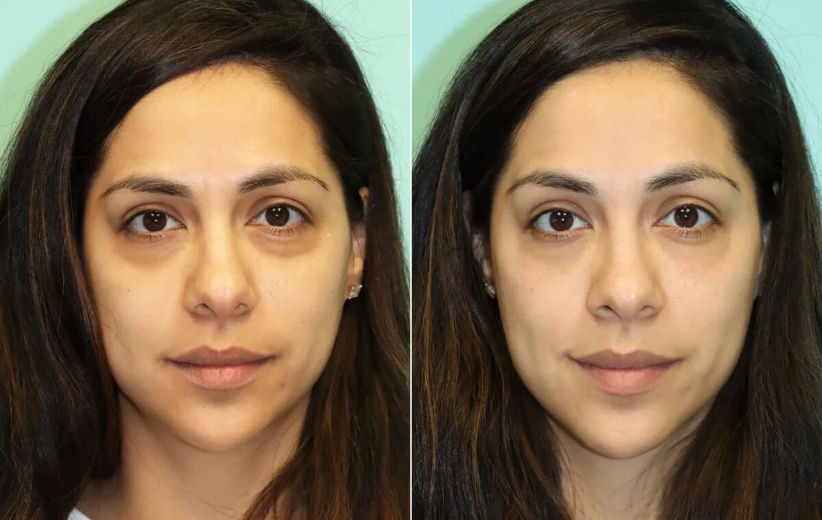 Филлер и ботокс разница. Tear Trough correction. Dark Eye Filler. Under Eye Filler Injection for Dark circles.