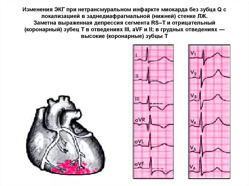 ЭКГ при нетрансмурального инфаркта миокарда. Острый Нижний (заднедиафрагмальный) инфаркт миокарда ЭКГ. Передний инфаркт миокарда без зубца q. ЭКГ при инфаркте без зубца q. Изменение боковой стенки левого желудочка