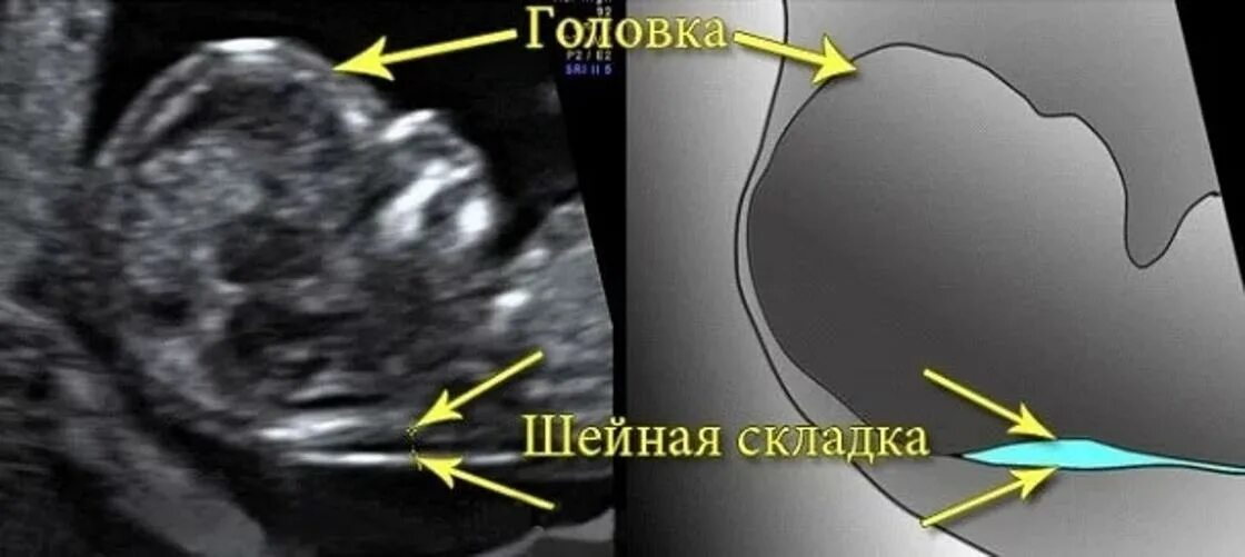 Диагноз 12 недель. УЗИ 1 триместр беременности синдром Дауна. ТВП 12 недель синдром Дауна. Толщина воротникового пространства УЗИ.