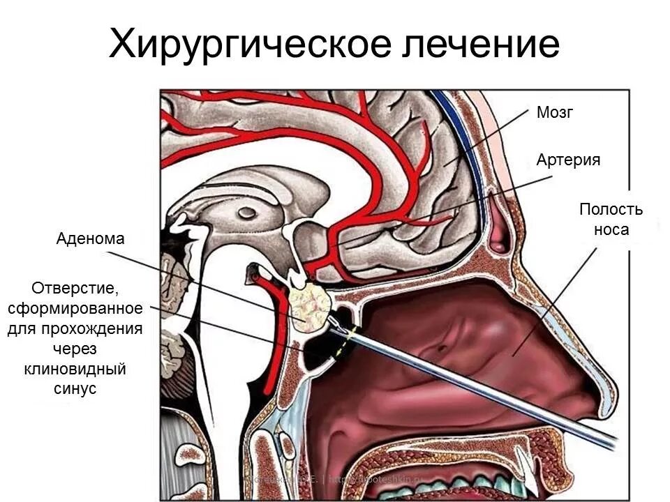 Полость страдать. Трансназальная хирургия аденомы гипофиза. Транссфеноидальная аденомэктомия. Опухоль аденома гипофиза. Эндоскопическая эндоназальная транссфеноидальная аденомэктомия.