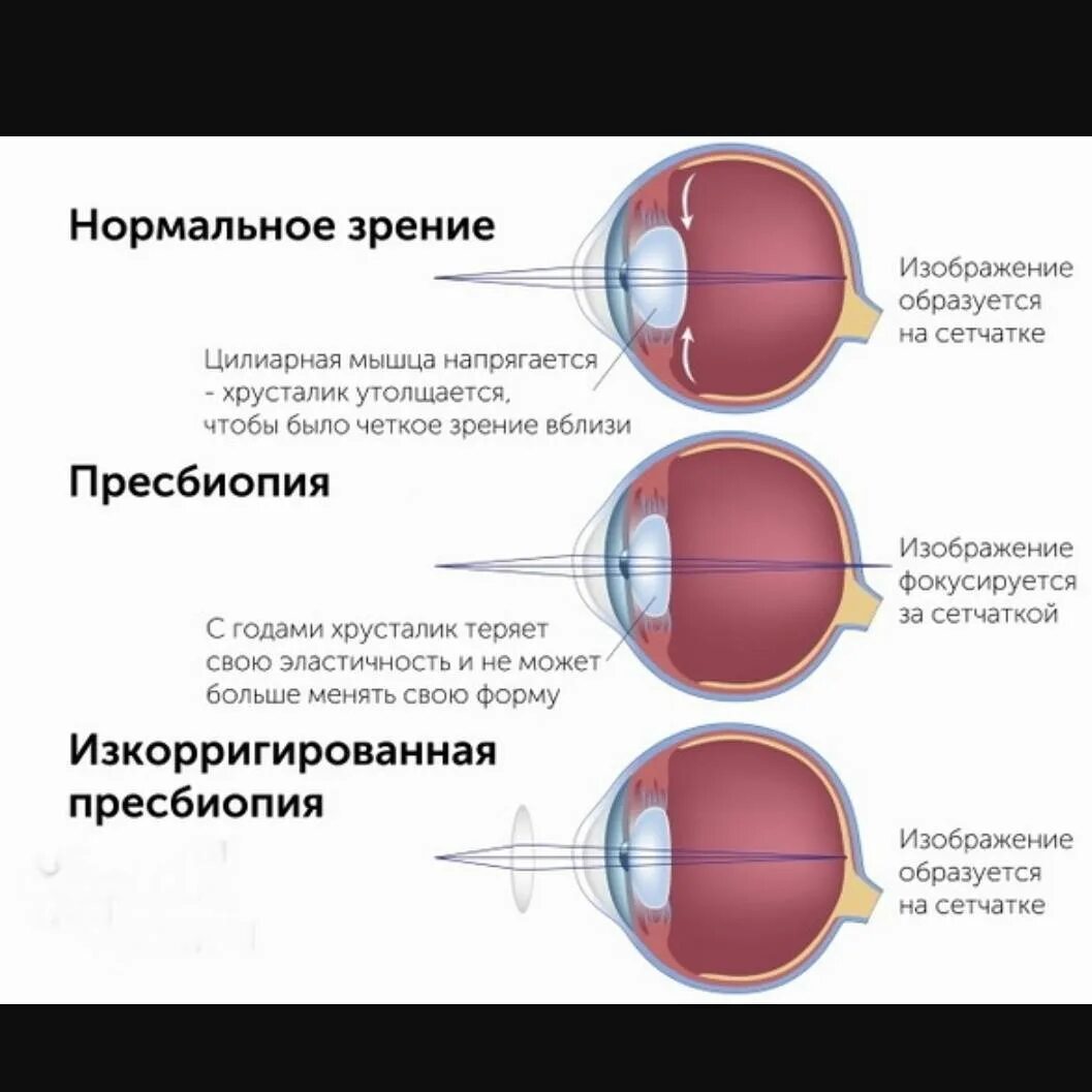 Плохо вижу вблизи это плюс или минус