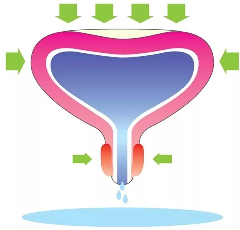 Недержание мочи у женщин. Стрессовое недержание мочи у мужчин. Недержание мочи мочевой пузырь. Недержание мочи у женщин рисунки.