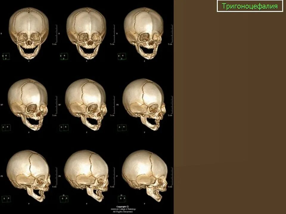 Черепная аномалия. Мальформация костей черепа. Аномалии затылочной кости черепа. Аномалии костей мозгового отдела черепа. Врожденные аномалии черепа кт.