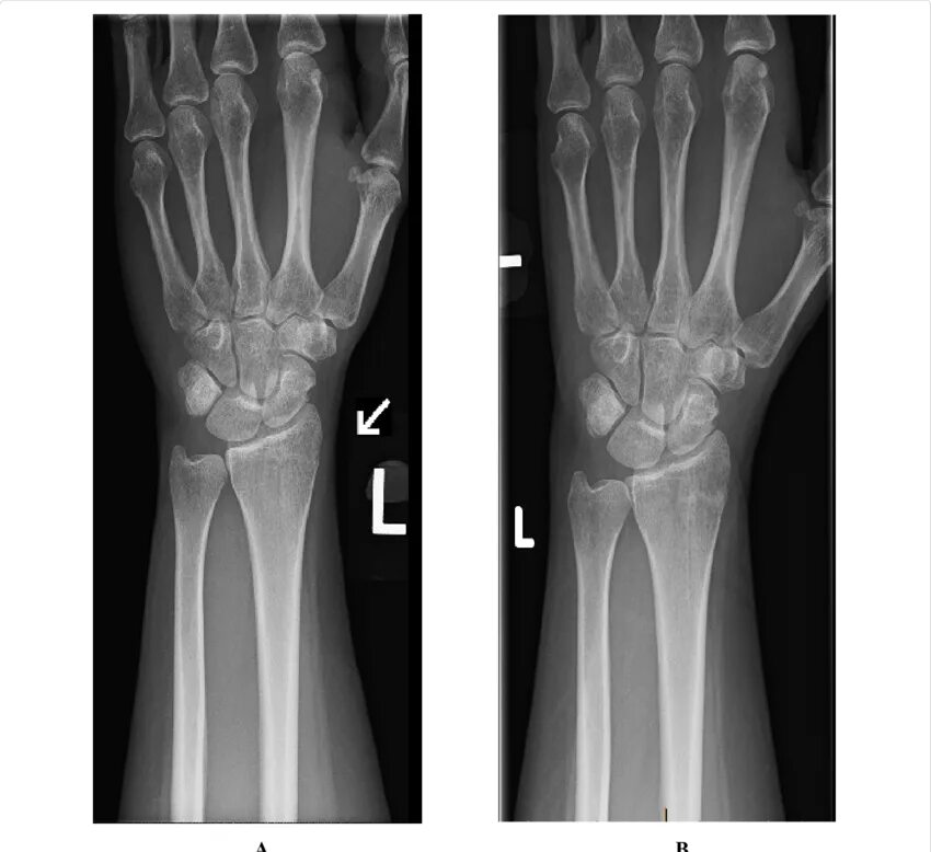 Radius fracture. Distal radius plate. treatment of distal fractures. дистал болдирлар аро синдезмоз.