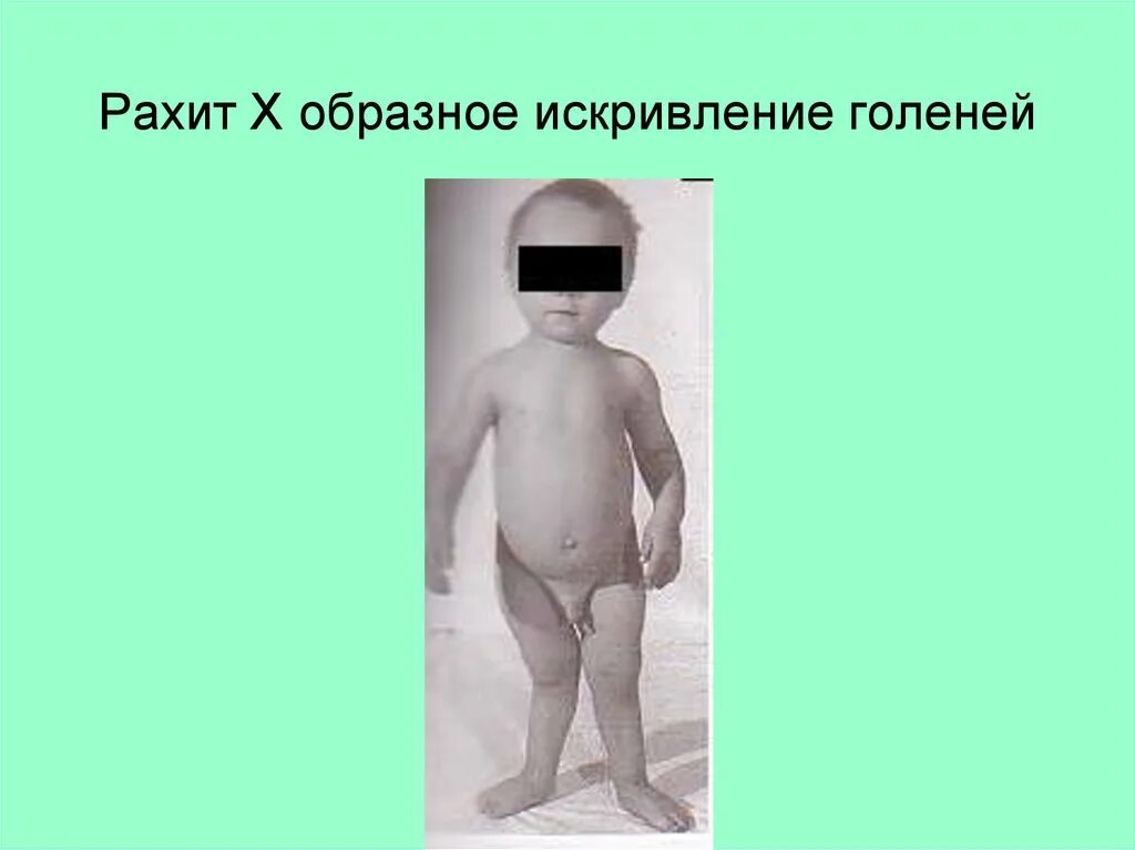 Где рахит. Фосфоропенический рахит. наследственные заболевания рахит.