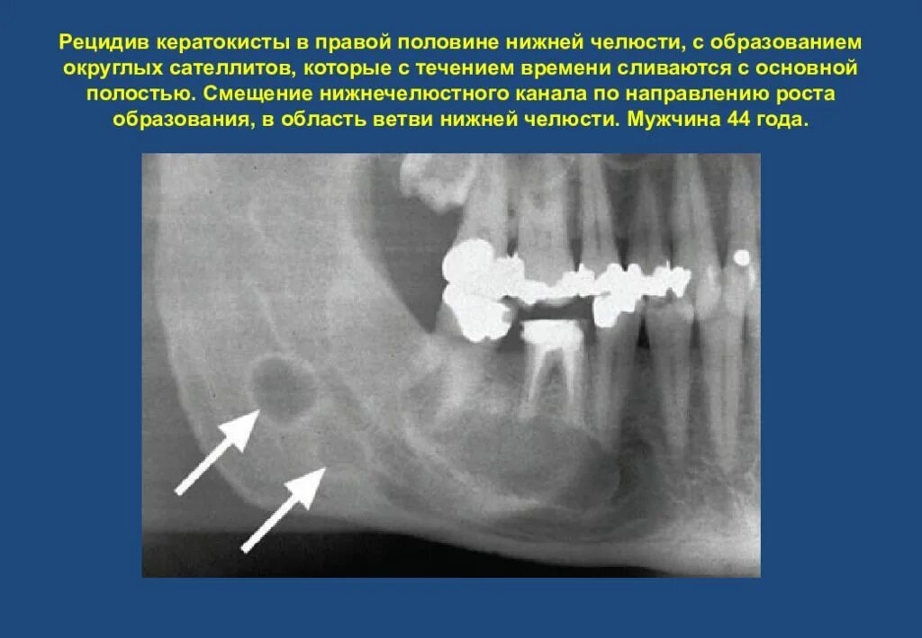 Шлобуломакстллярная киста. Первичная киста кератокиста. Фолликулярная киста челюсти кт. Кератокиста нижней челюсти рентген. Рецидив образуют