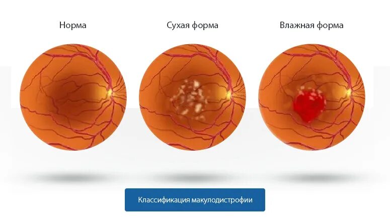 Возрастная макулодистрофия лечение. Возрастная макулодистрофия лечение