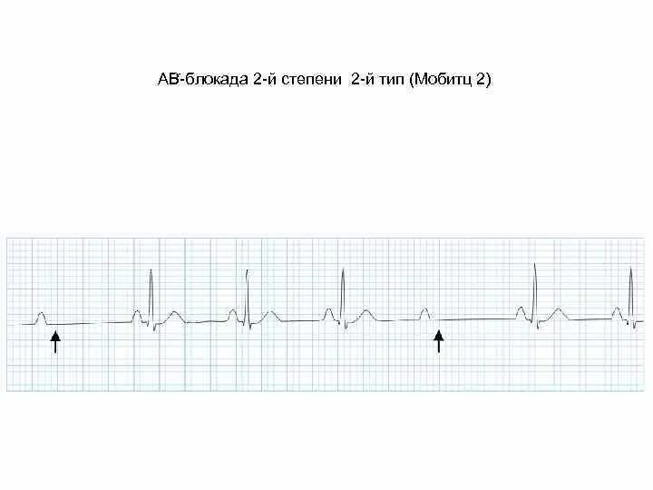 Атриовентрикулярная блокада 2. ЭКГ атриовентрикулярная блокада Мобитц 2. Av блокада Мобитц 2 ЭКГ. АВ блокада II степени Тип Мобитц II. АВ-блокады II степени II типа (Мобитц II),.