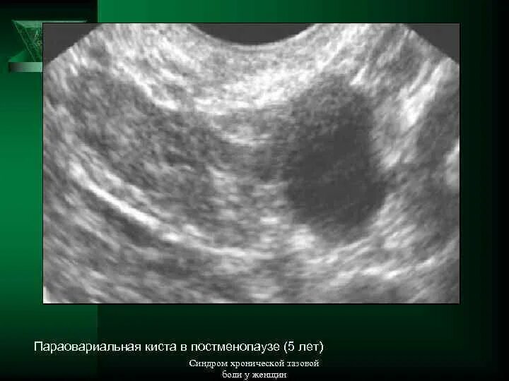 Почему в постменопаузе. Образования яичников на УЗИ. Параовариальные кисты яичника. Параовариальная киста на УЗИ.