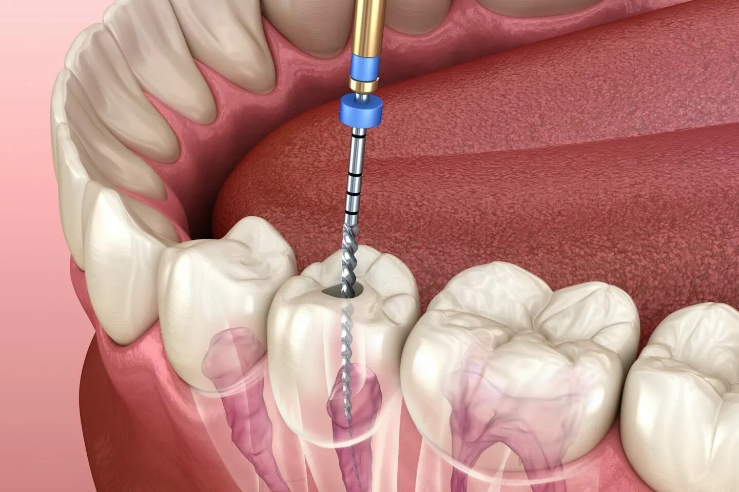 Root canal